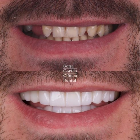 carillas-dentales-caso-antes-despues-001