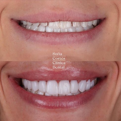 carillas-dentales-caso-antes-despues-002