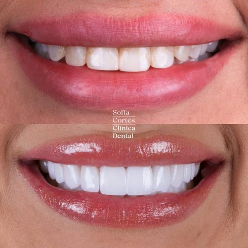 carillas-dentales-caso-antes-despues-004