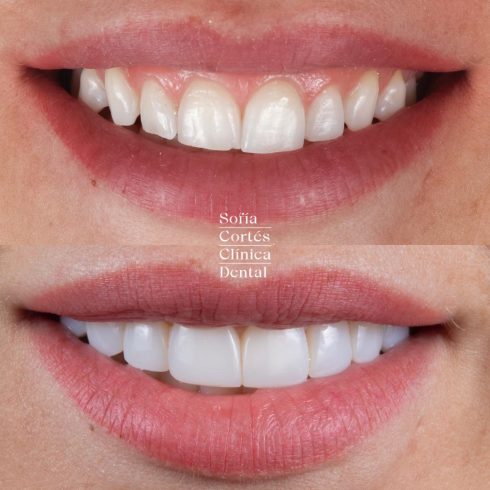 carillas-dentales-caso-antes-despues-006