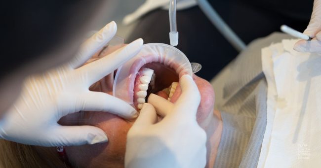 carillas-dentales-especialistas-en-valencia carillas-dentales-especialistas-en-valencia