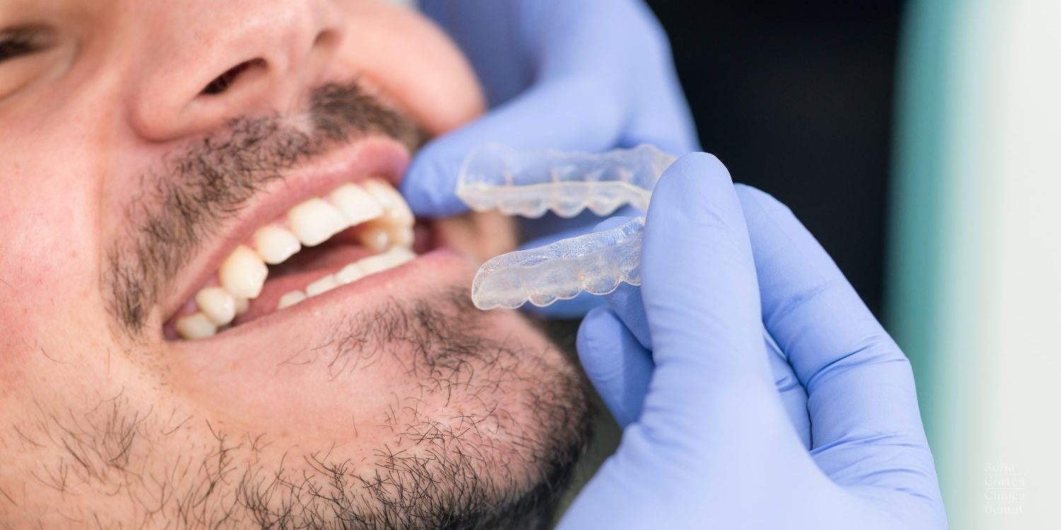 ortodoncia-invisible-antes-de-carillas-valencia ortodoncia-invisible-antes-de-carillas-valencia