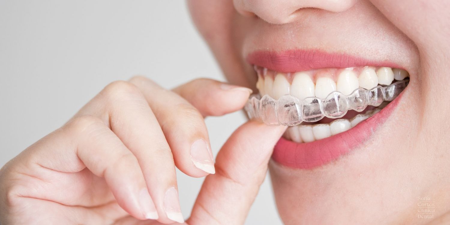ortodoncia-invisible-invisalign-con-carillas-valencia ortodoncia-invisible-invisalign-con-carillas-valencia