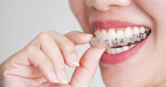 ortodoncia-invisible-invisalign-con-carillas-valencia ortodoncia-invisible-invisalign-con-carillas-valencia