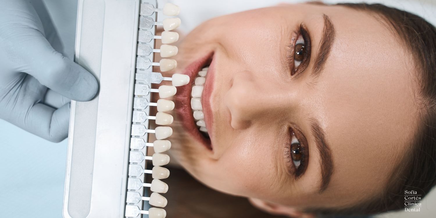 carillas-dentales-guia-completa-para-el-tratamiento carillas-dentales-guia-completa-para-el-tratamiento