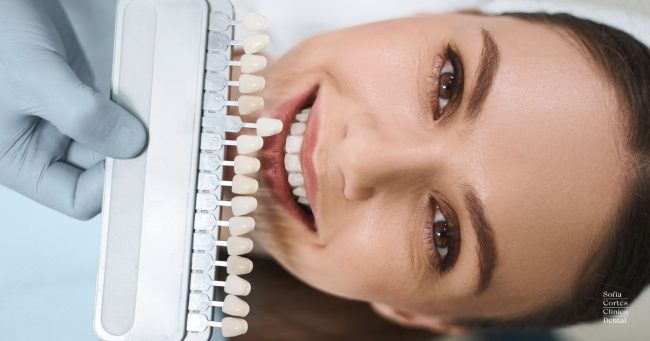 carillas-dentales-guia-completa-para-el-tratamiento carillas-dentales-guia-completa-para-el-tratamiento