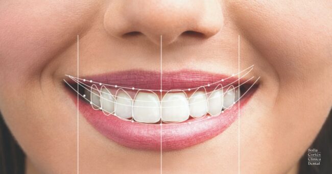 diseño-de-sonrisas-smile-design-valencia diseño-de-sonrisas-smile-design-valencia