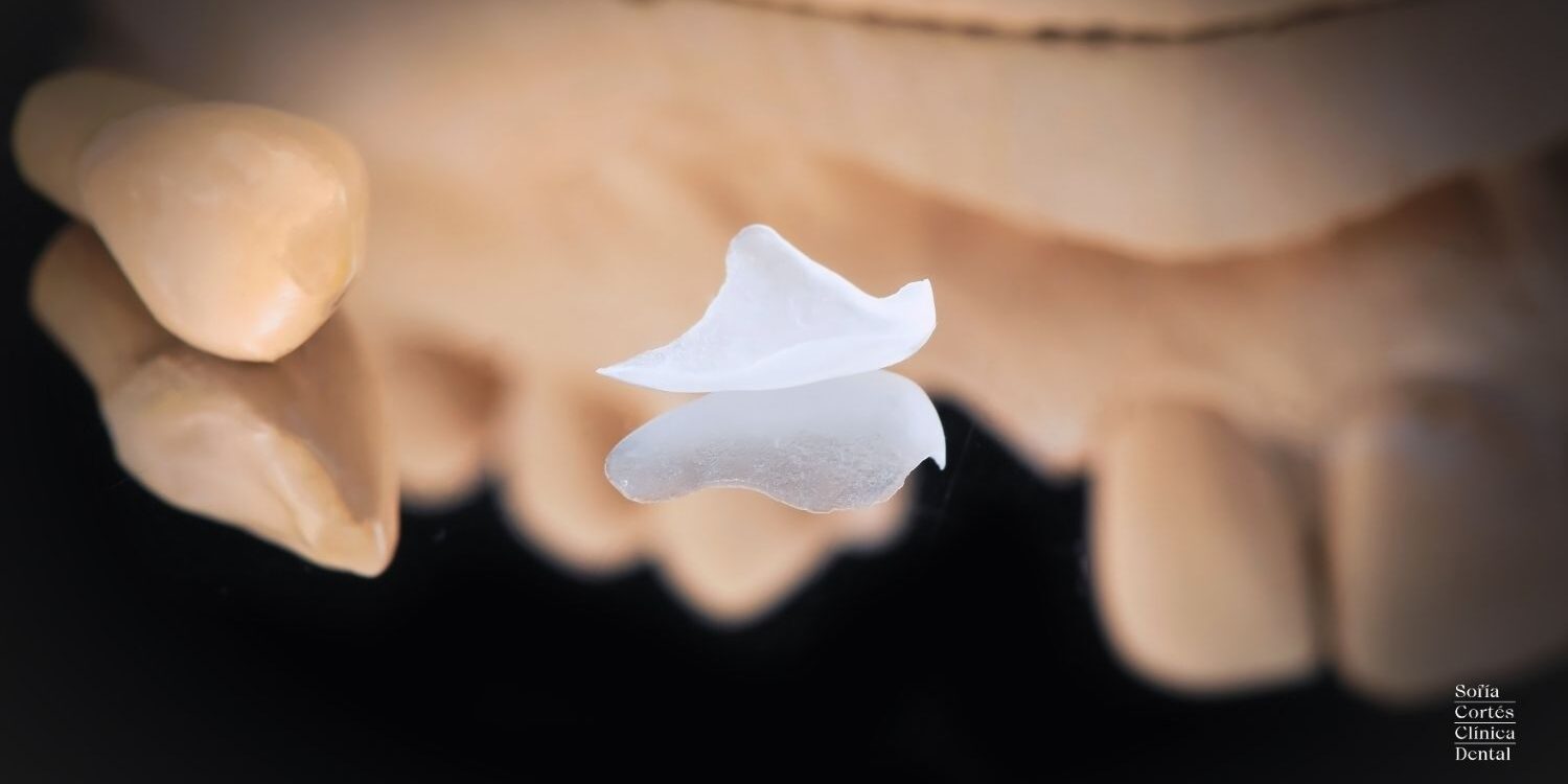 carillas-dentales-sin-preparacion-valencia carillas-dentales-sin-preparacion-valencia