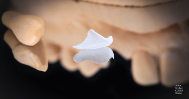 carillas-dentales-sin-preparacion-valencia carillas-dentales-sin-preparacion-valencia