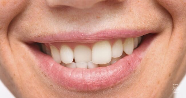 corregir-dientes-torcidos-valencia corregir-dientes-torcidos-valencia