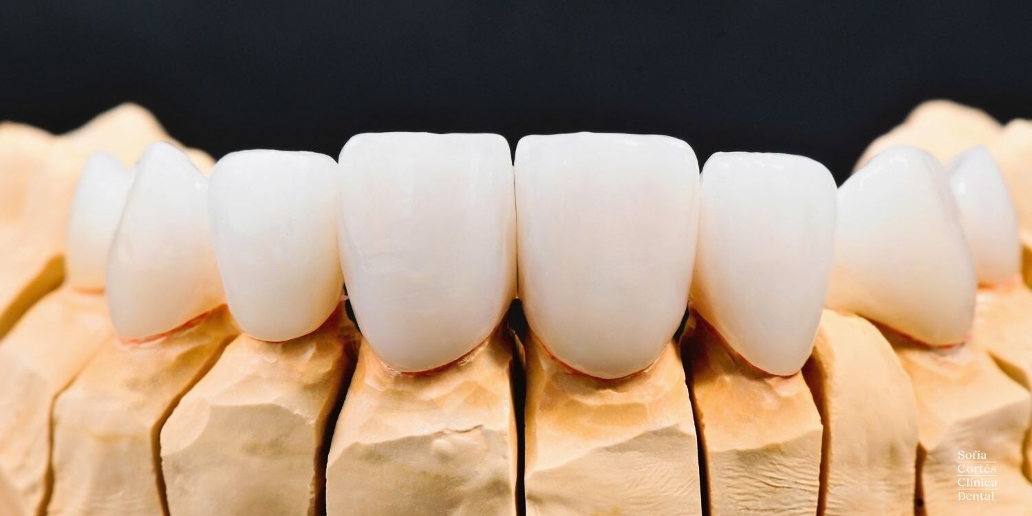 mock-up-dental-diseño-sonrisa-valencia mock-up-dental-diseño-sonrisa-valencia