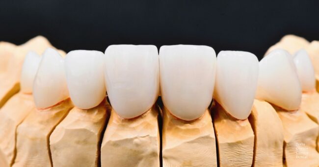 mock-up-dental-diseño-sonrisa-valencia mock-up-dental-diseño-sonrisa-valencia