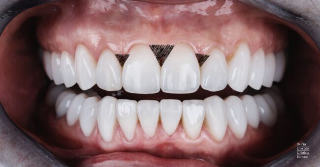 troneras-dentales-correccion-con-resina-en-valencia Troneras Dentales o espacios negros entre dientes - Corrección con resina en Valencia