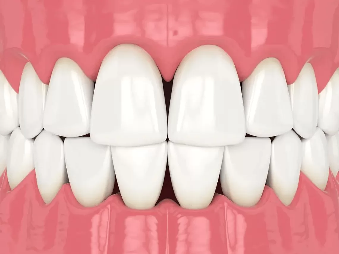 troneras-dentales-espacios-negros-entre-dientes