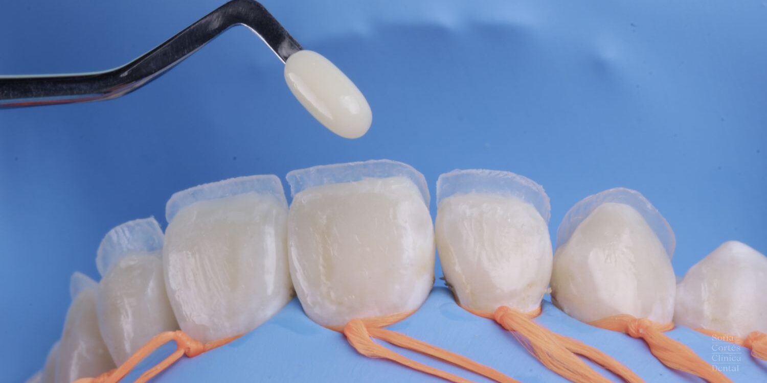 curso-composite-dental-valencia Curso para Odontólogos de composite dental en Valencia