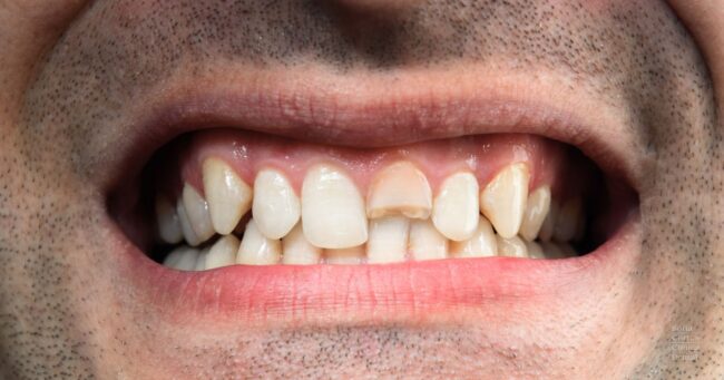 diente-roto-fractura-dental-dentista-valencia-sofia-cortes diente-roto-fractura-dental-dentista-valencia-sofia-cortes