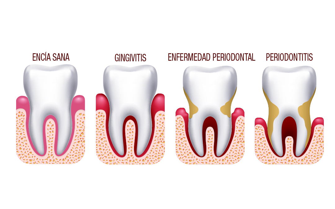 enfermedad-periodontal