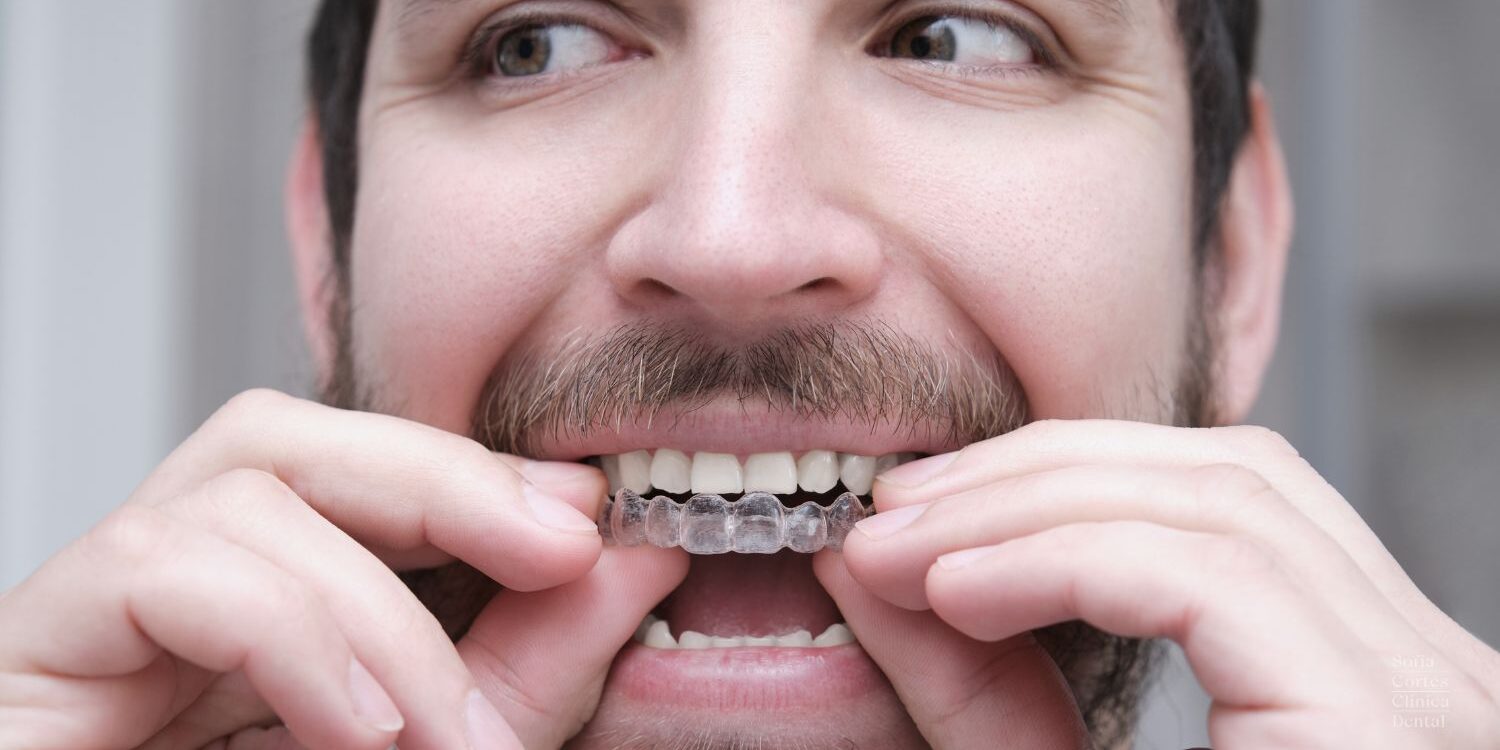 solucion-mordida-cruzada-con-ortodoncia-invisible-valencia solucion-mordida-cruzada-con-ortodoncia-invisible-valencia
