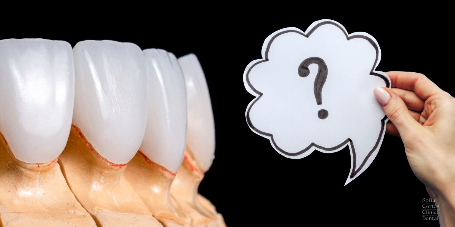 carillas-dentales-preguntas-frequentes