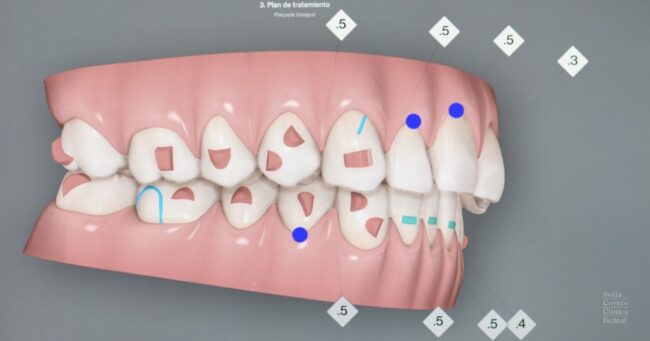 clincheck-invisalign-ortodoncia-invisible-valencia clincheck-invisalign-ortodoncia-invisible-valencia