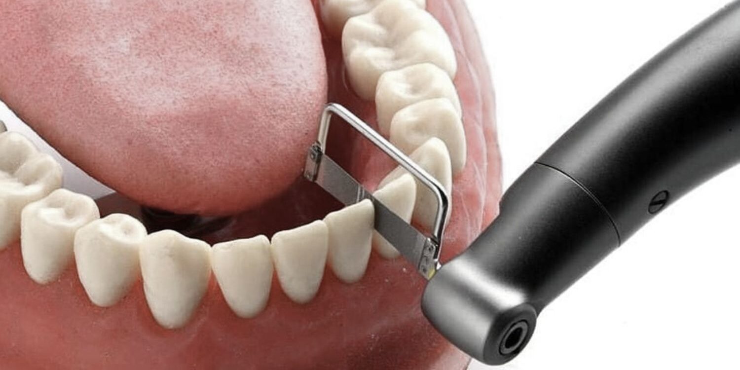 stripping-dental-ortodoncia-valencia stripping-dental-ortodoncia-valencia