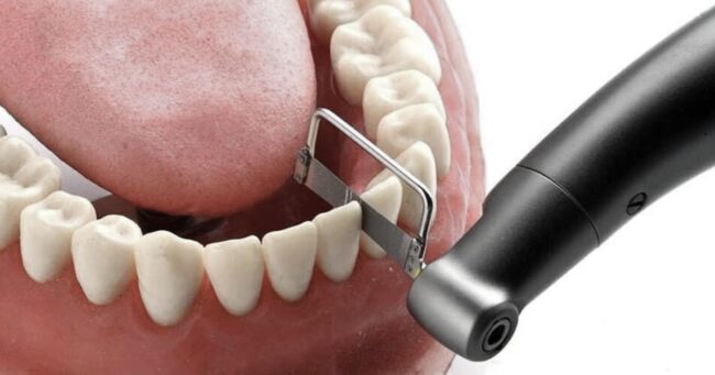 stripping-dental-ortodoncia-valencia stripping-dental-ortodoncia-valencia