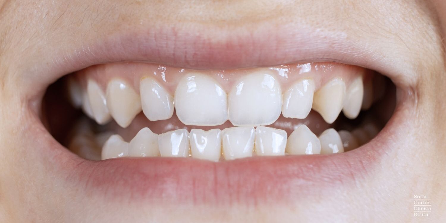 ortodoncia-invisible-para-maloclusion-en-valencia
