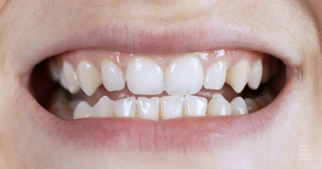 ortodoncia-invisible-para-maloclusion-en-valencia ortodoncia-invisible-para-maloclusion-en-valencia