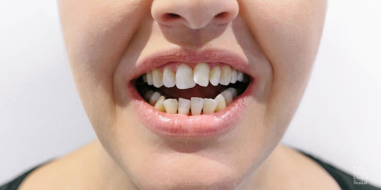 dientes-torcidos-tratamientos