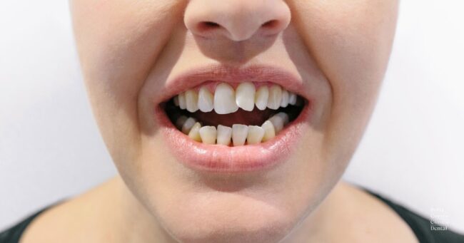 dientes-torcidos-tratamientos dientes-torcidos-tratamientos