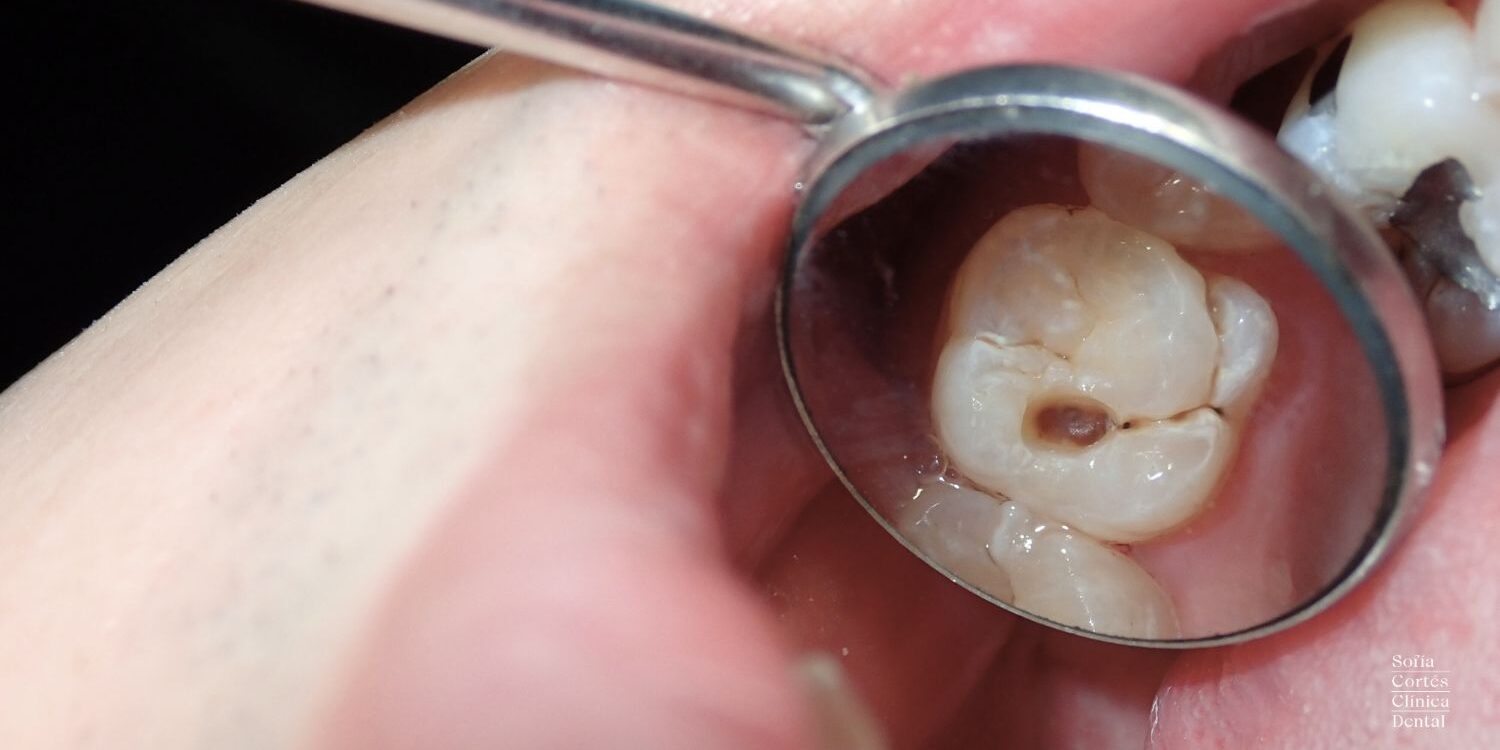 fisuras-dentales-valencia-sofia-cortes fisuras-dentales-valencia-sofia-cortes