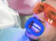 blanqueamiento-dental-preguntas-y-respuestas-frecuentes