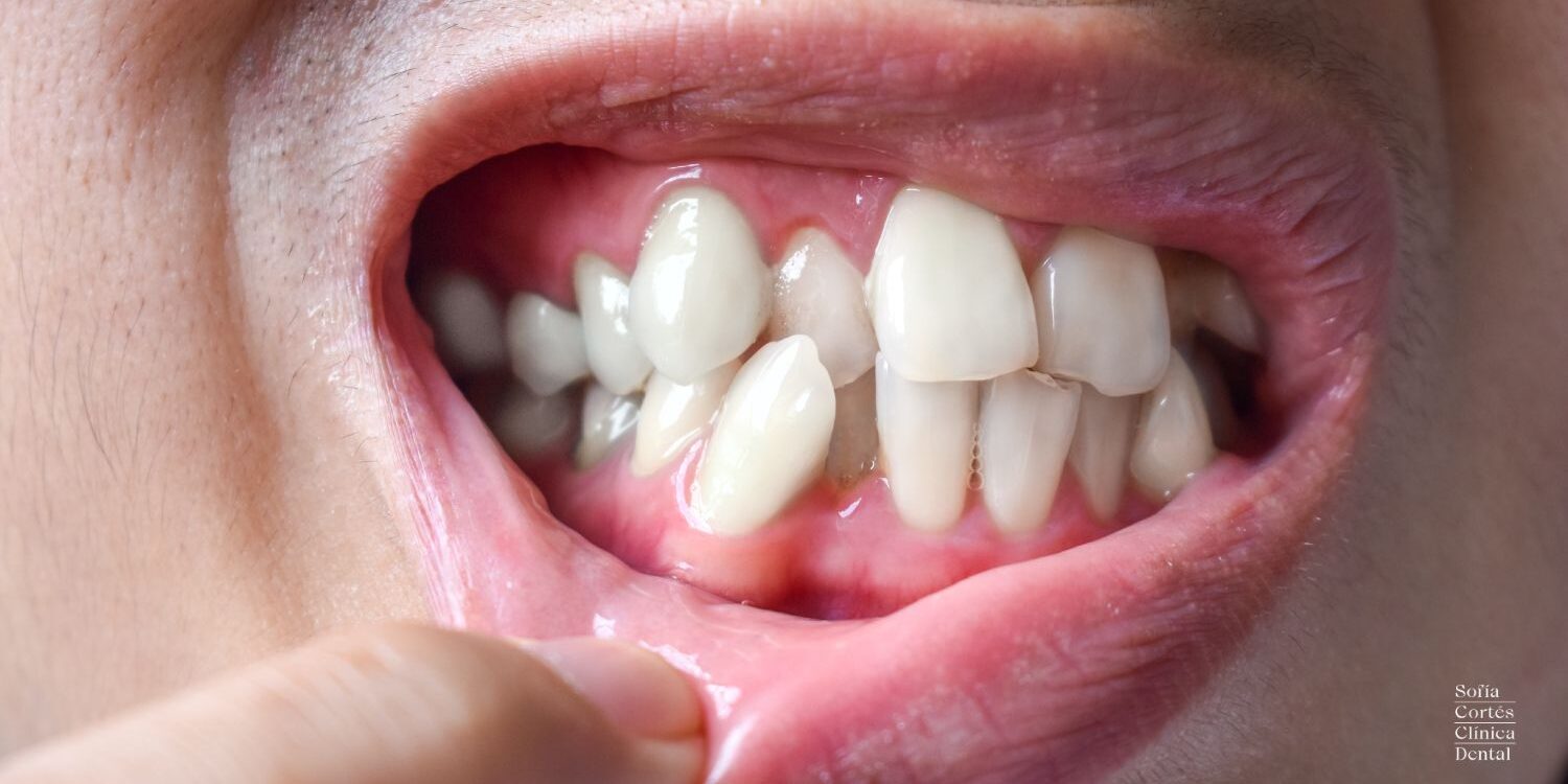 colmillos-montados colmillos-montados-Valencia