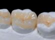 incrustaciones-dentales-composite-valencia