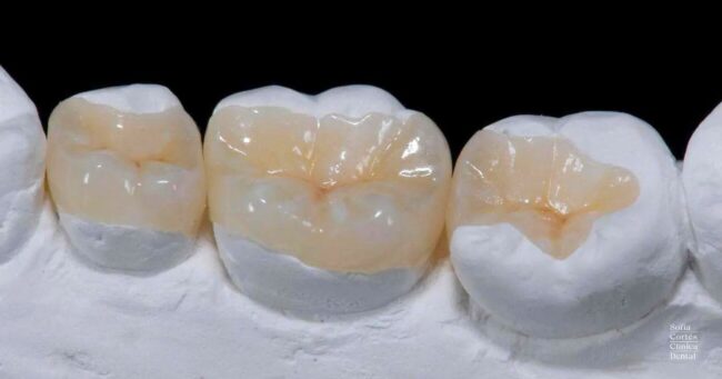 incrustaciones-dentales-composite-valencia incrustaciones-dentales-composite-valencia
