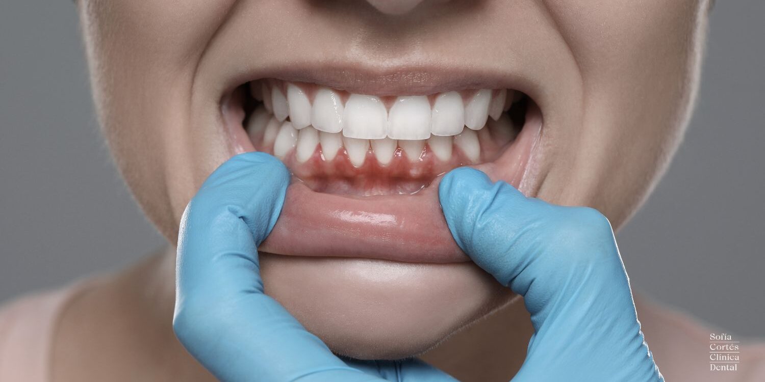 Sofía Cortés – Enfermedades periodontales Enfermedades periodontales