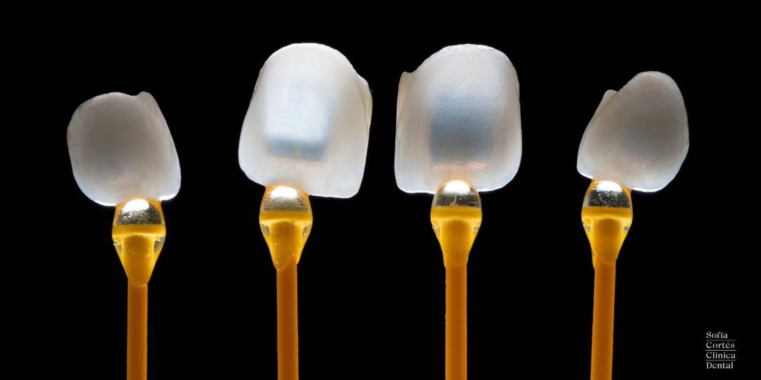 Carillas o coronas dentales